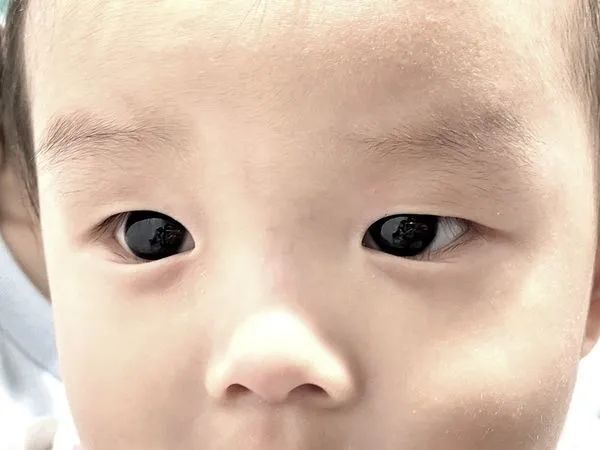 亚裔男婴深棕色眼睛一夜之间变成了亮蓝色，竟是因为新冠治疗